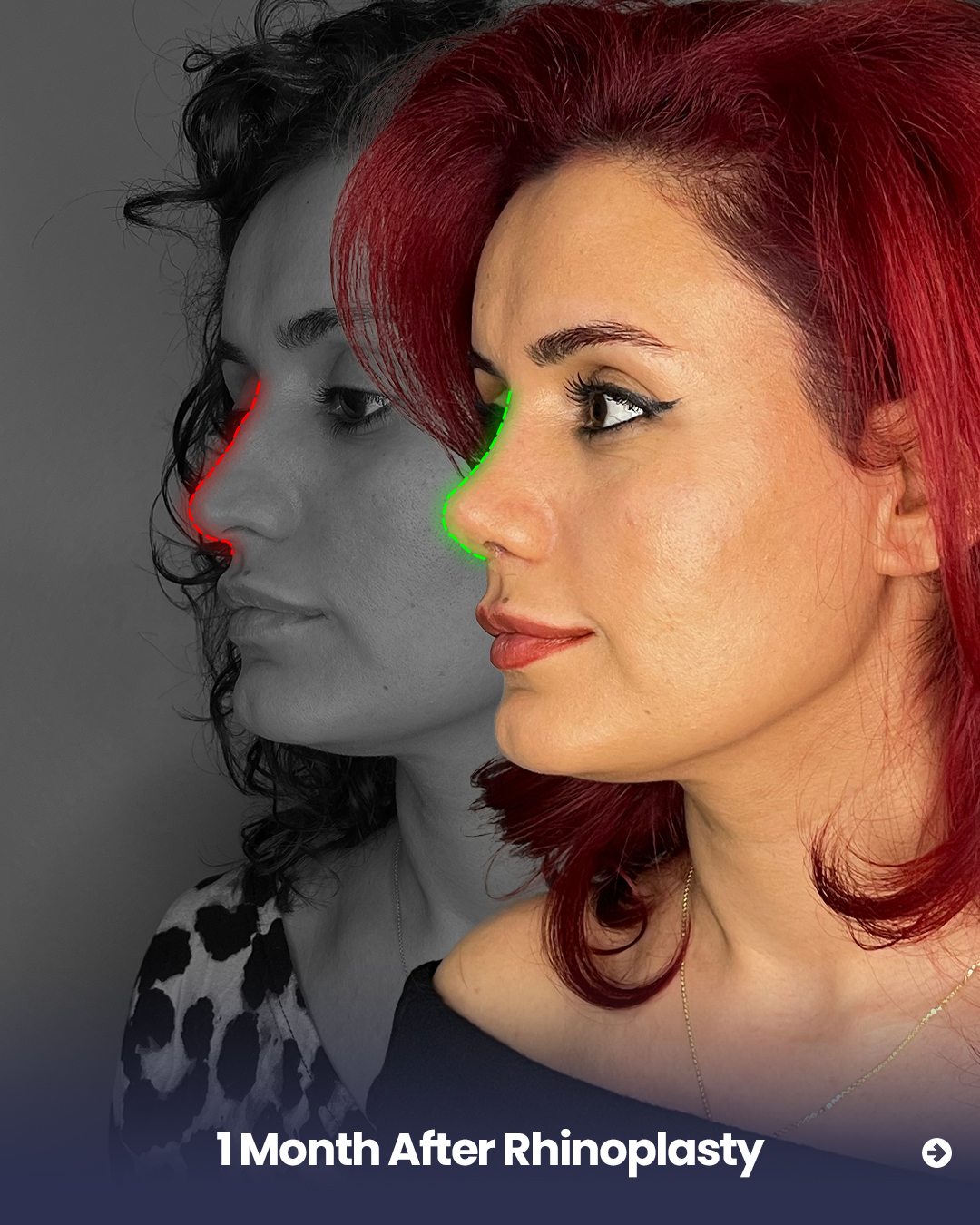 1 month after rhinoplasty comparison showing before and after side profile with improved nose shape and contour