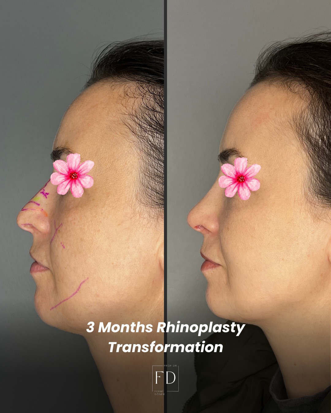 3 months rhinoplasty before and after side profile showing nose reshaping and facial harmony improvement