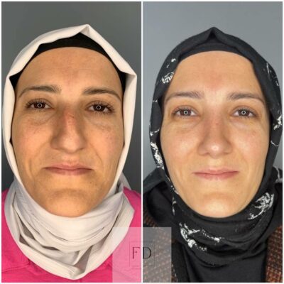 Before and after facial rejuvenation treatment showing improvement in skin texture, reduced pigmentation, smoother complexion, and brighter, more even-toned skin