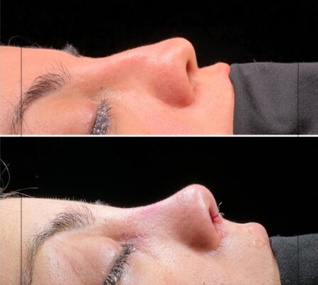 Before and after non-surgical nose filler treatment showing lifted nasal tip and smoother profile