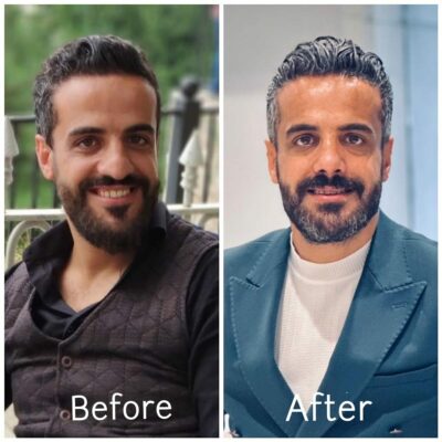 Before and after portrait of a bearded man showing transformation with improved grooming, hairstyle, and professional appearance in a stylish suit