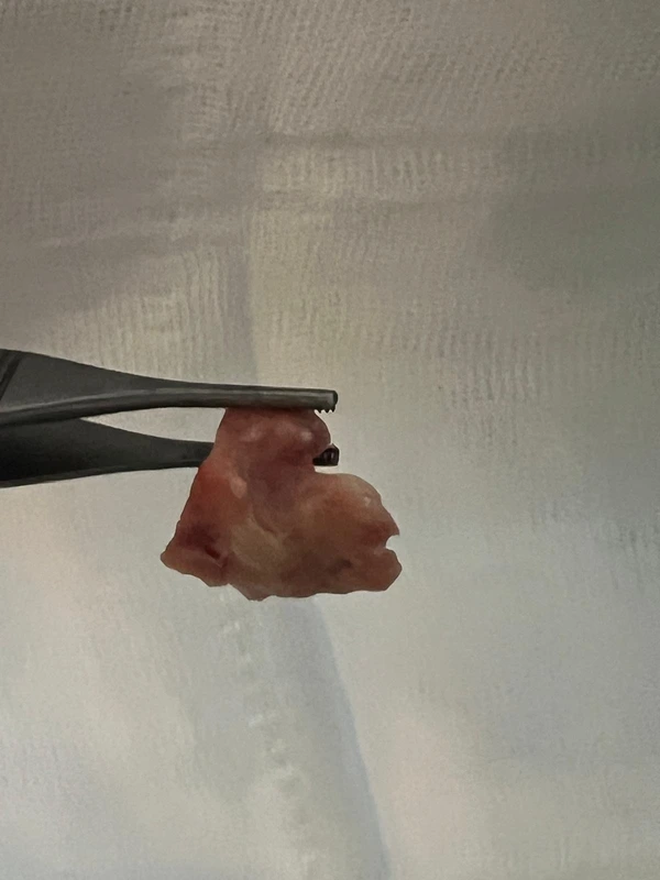 sinus-kanseri-ameliyati-cikarilan-tumor-dokusu