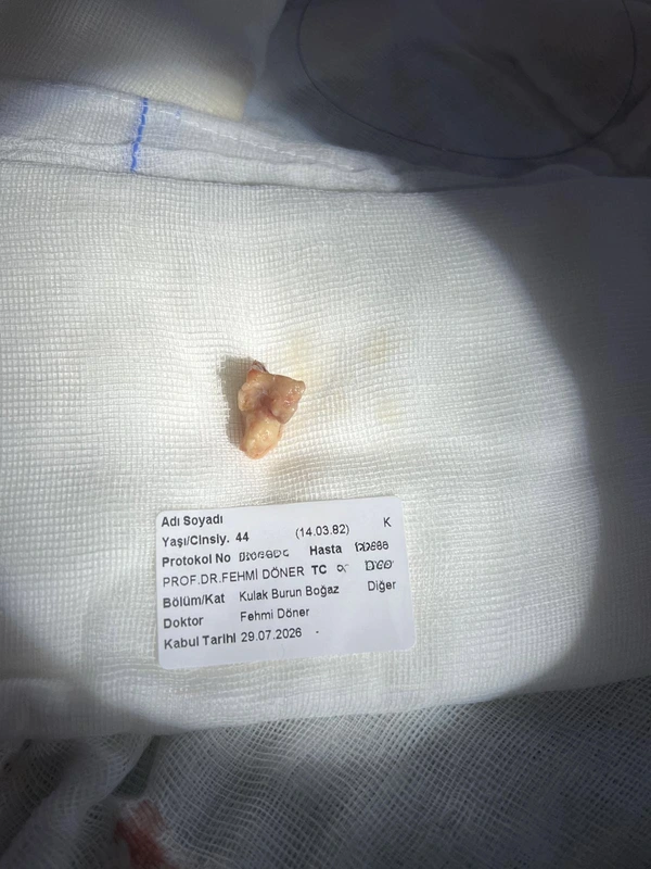 sinus-kanseri-ameliyati-cikarilan-tumor-dokusu2